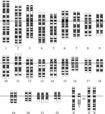 Down syndrome karyotype