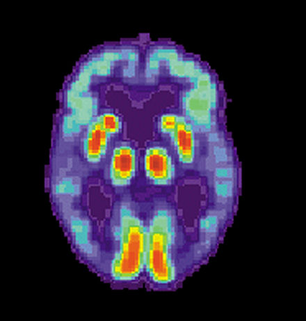 Alzheimer's and the brain