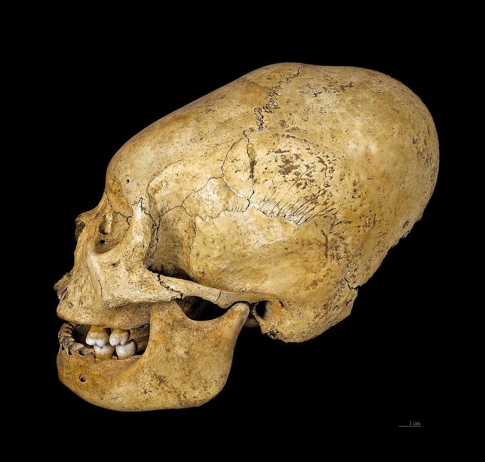 Skull showing signs of artificial cranial deformation