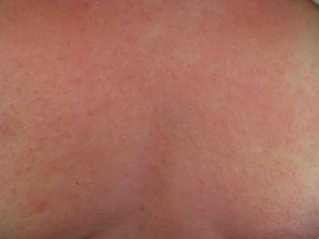 Hives and flushing on the back of a person with anaphylaxis